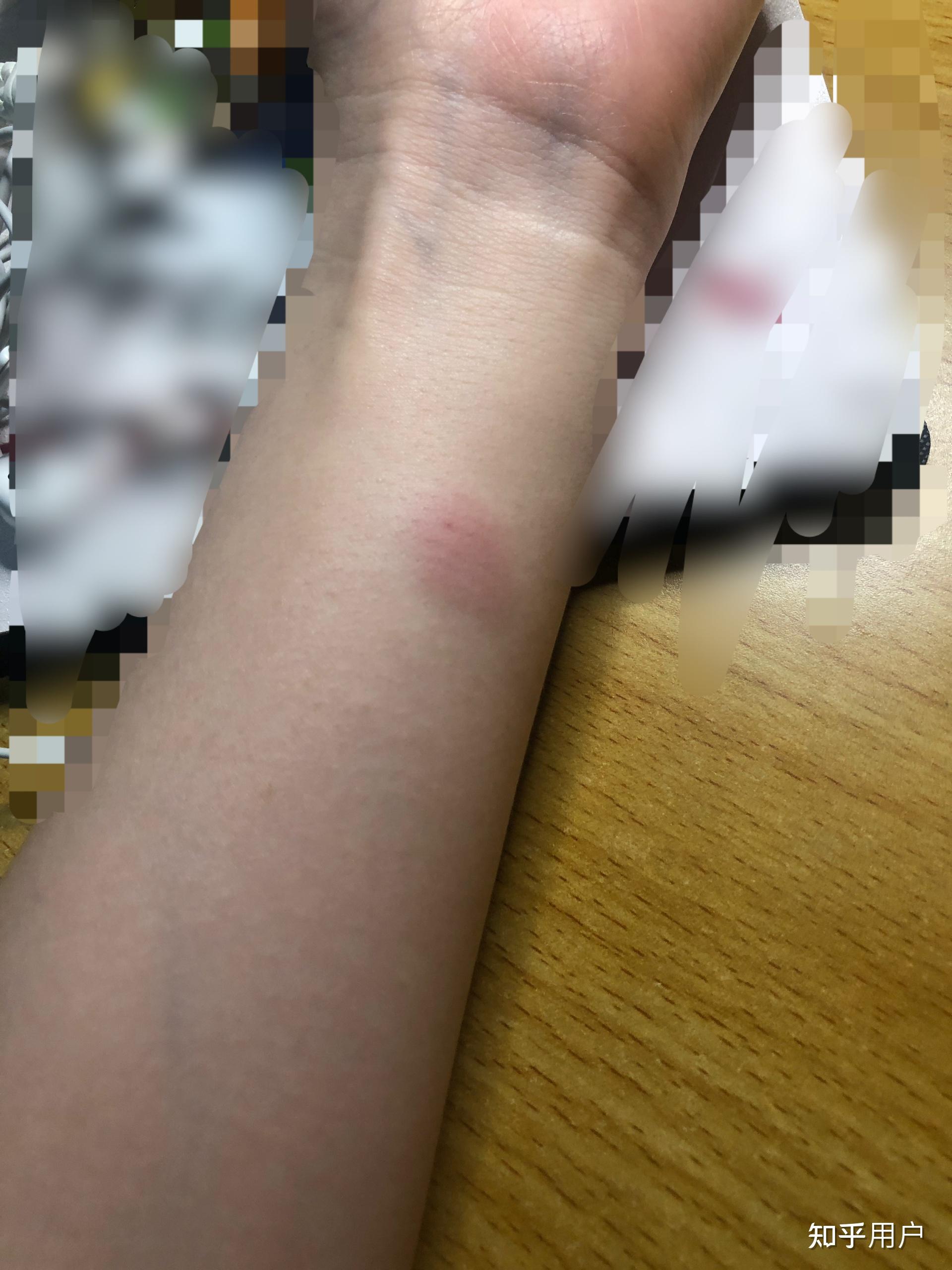 ppd皮试后这个样子怎么办