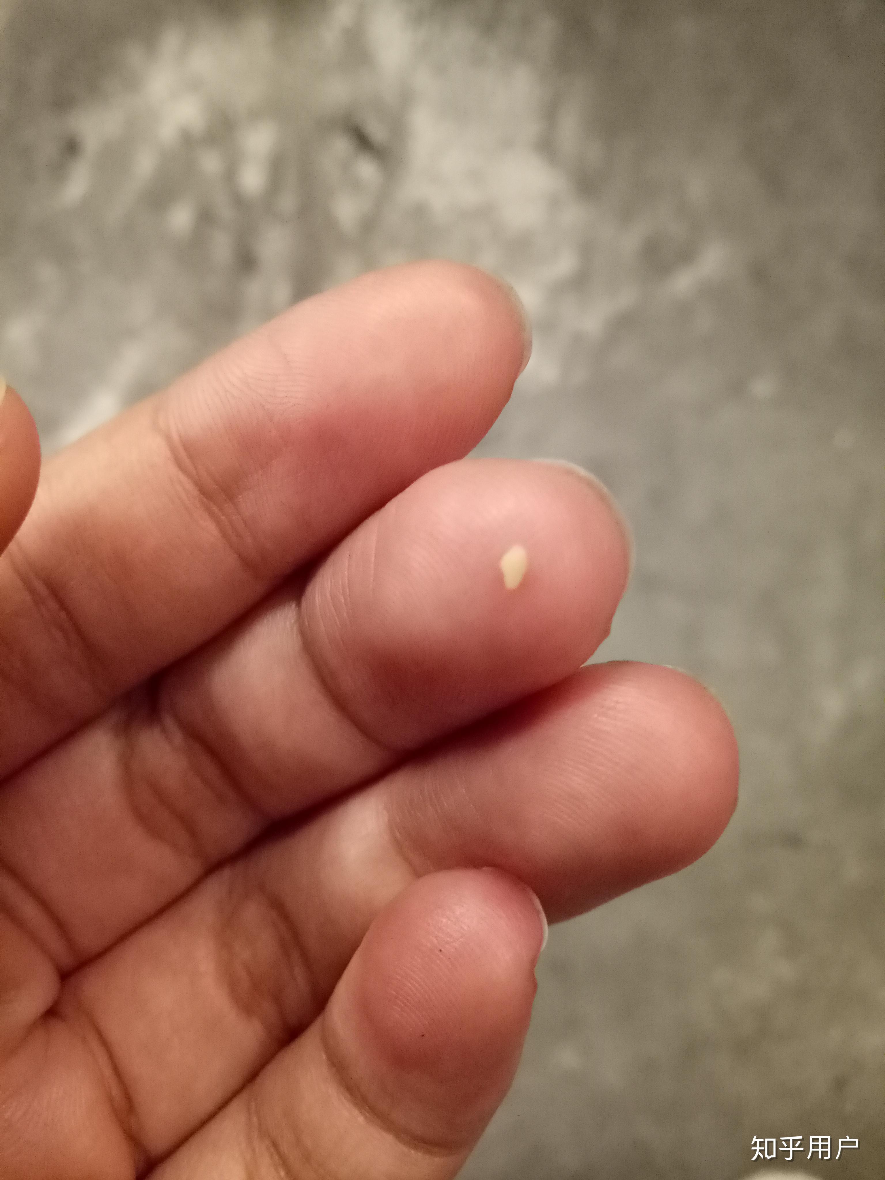 你见过最大的扁桃体结石有多大