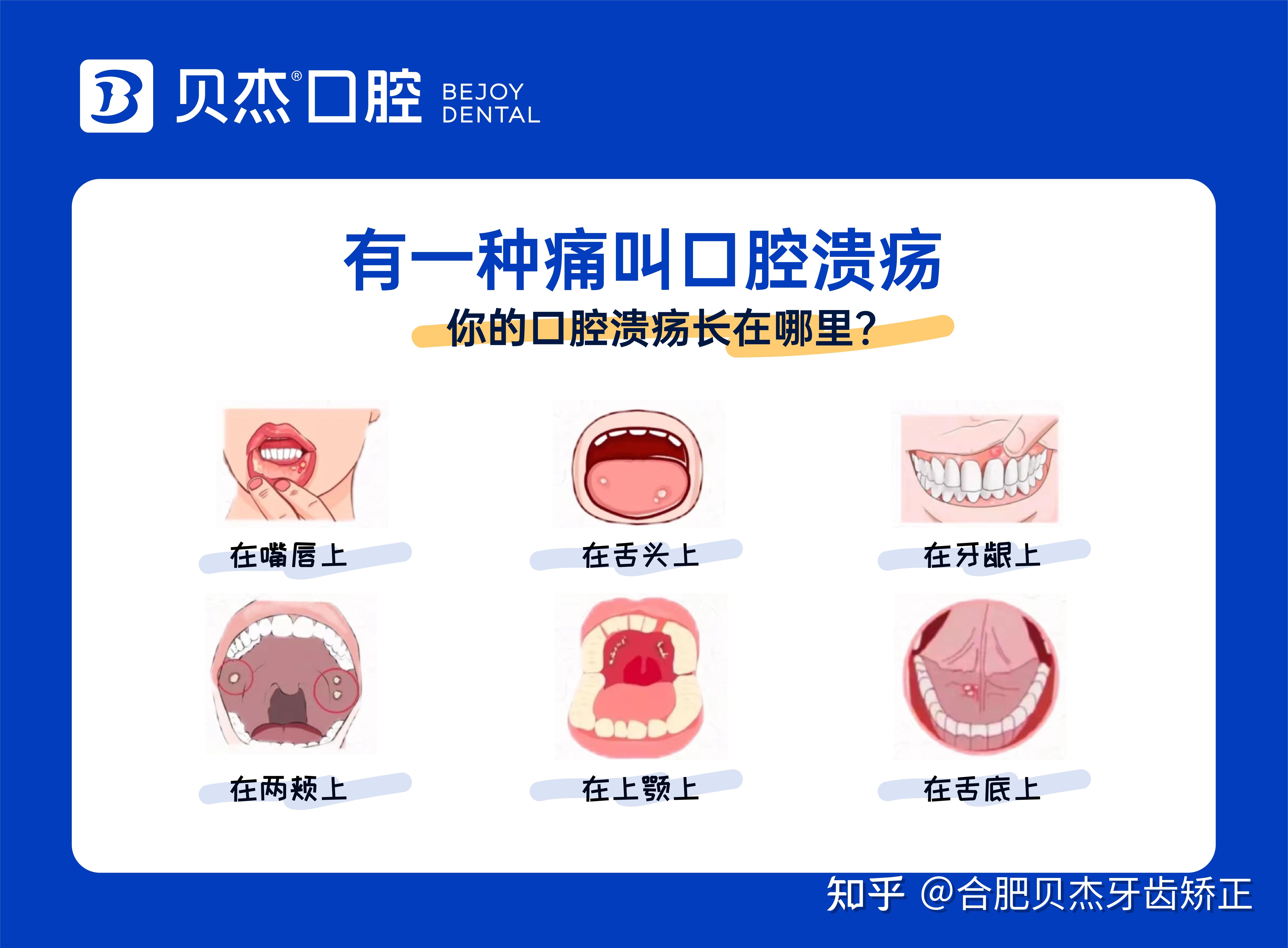 口腔溃疡发病原因图片图片