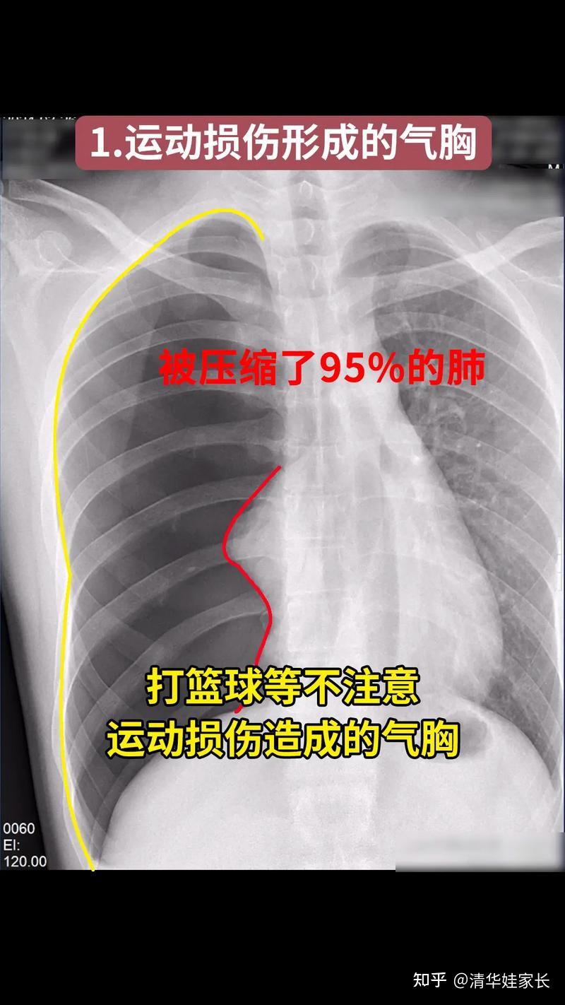 气胸 - 知乎