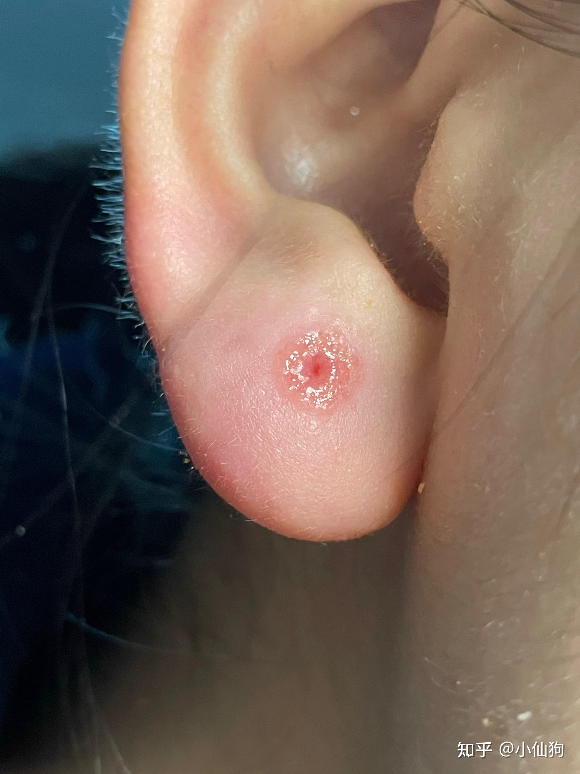 【急】打耳洞不到一个月,昨天不小心扯到耳钉了,今天肿的很厉害,还