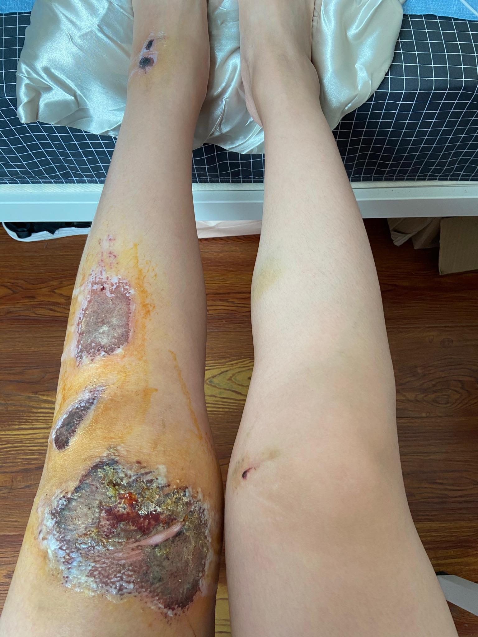 膝盖摔伤,抹了碘伏结痂后如何防止留疤? - 知乎