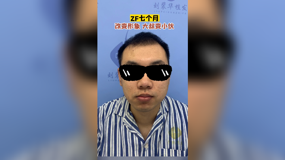 种植头发的费用是大概是多少钱