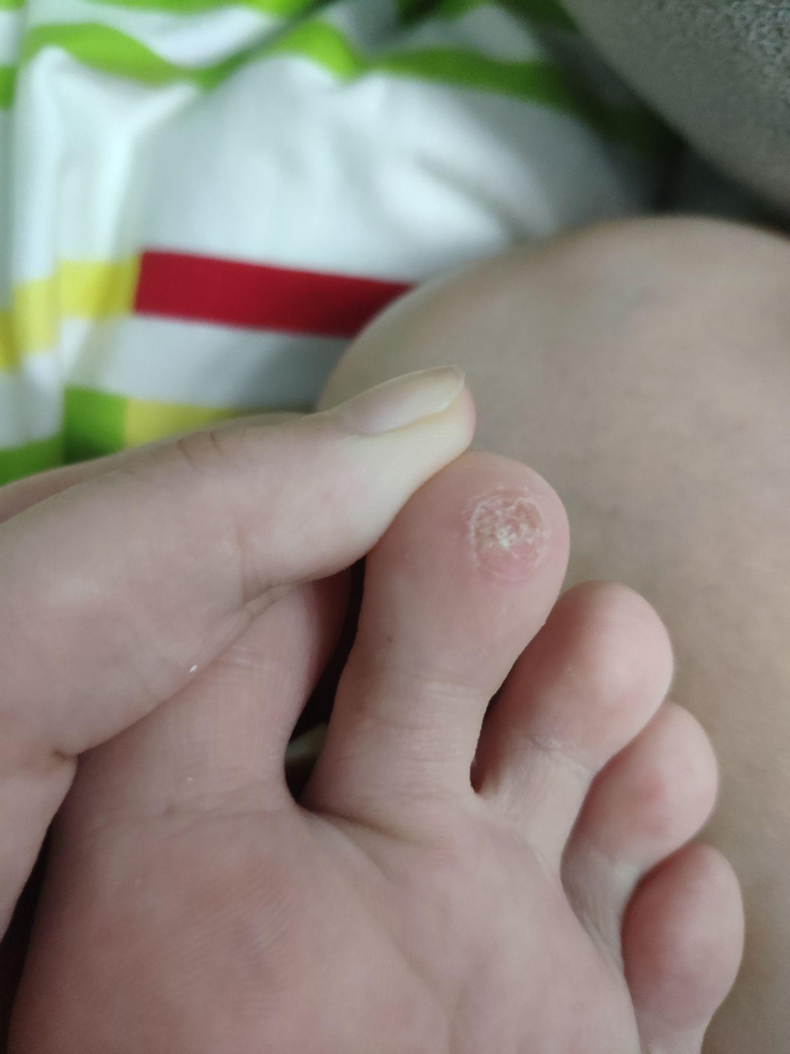 甲下寻常疣做液氮冷冻疼哭了,可耐受疼痛真的这么厉害吗?