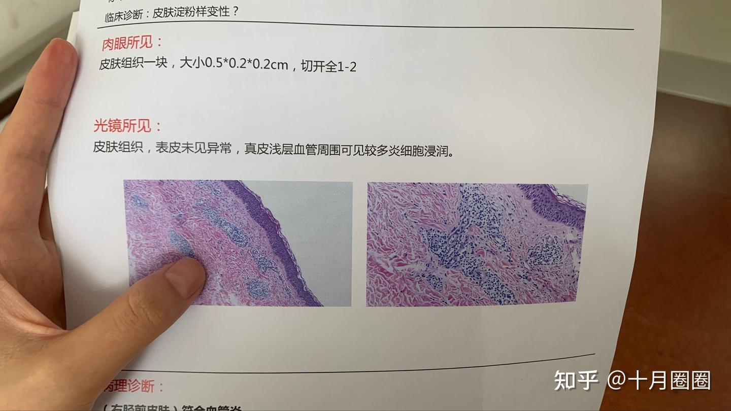 血管炎是什么? - 知乎