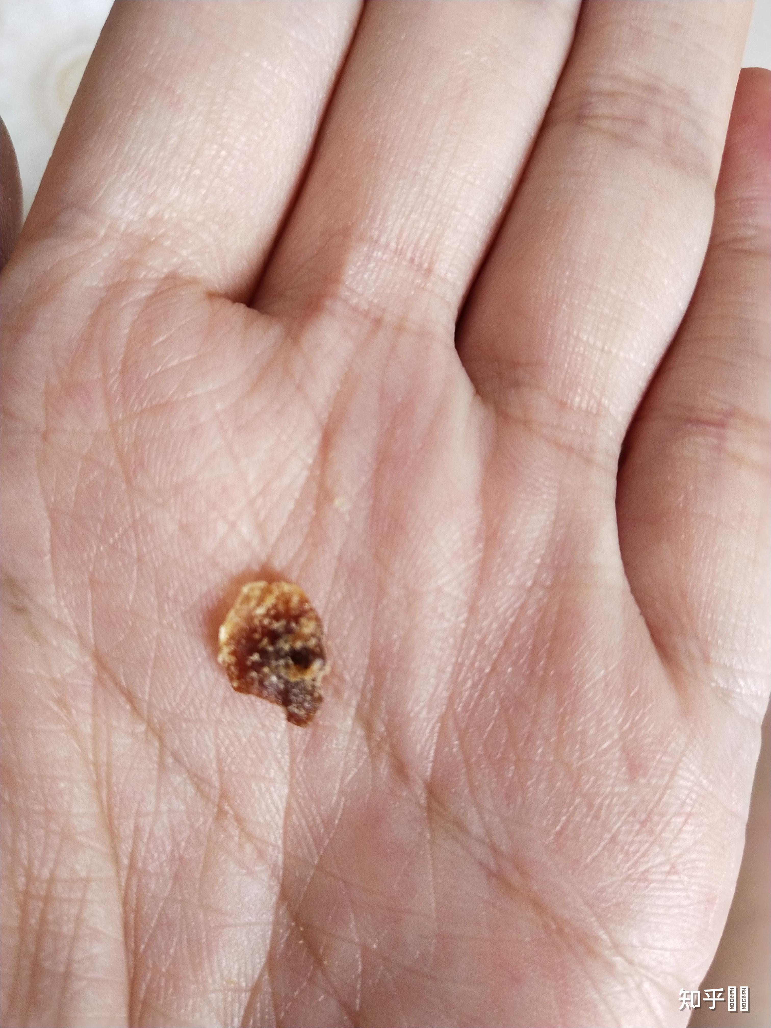 耳屎能大到什么程度? - 知乎