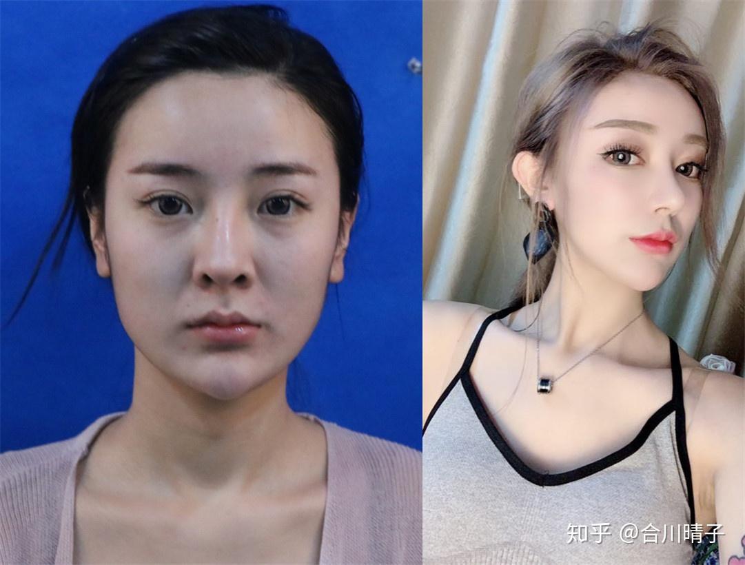 上海削骨磨骨医生哪个做得好有案列图吗