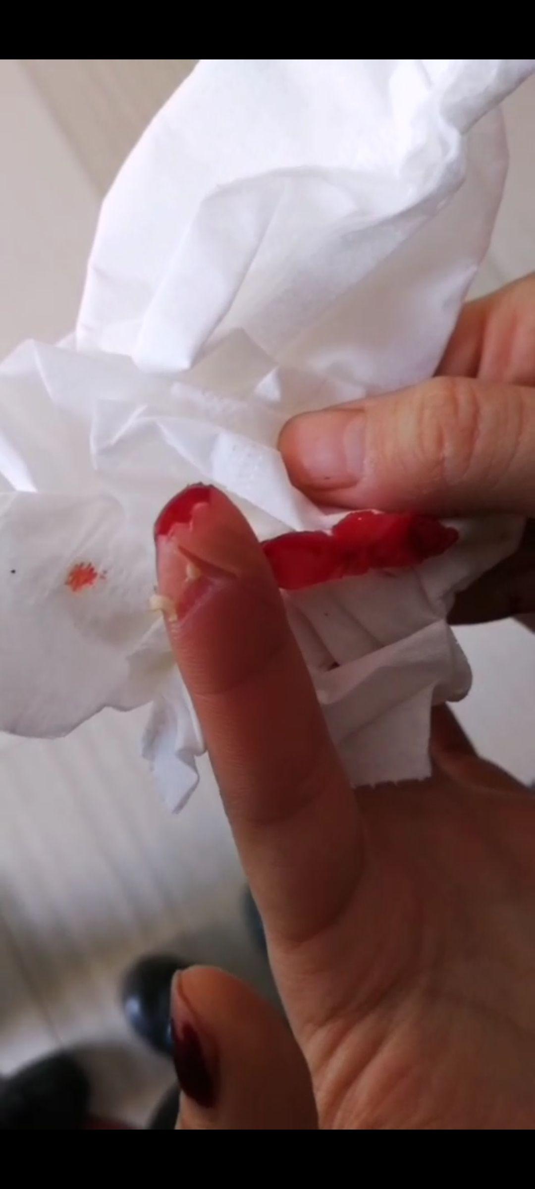 手指切断了还能康复吗? - 知乎