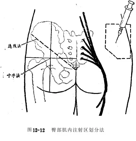 臀部肌肉注射位置图图片