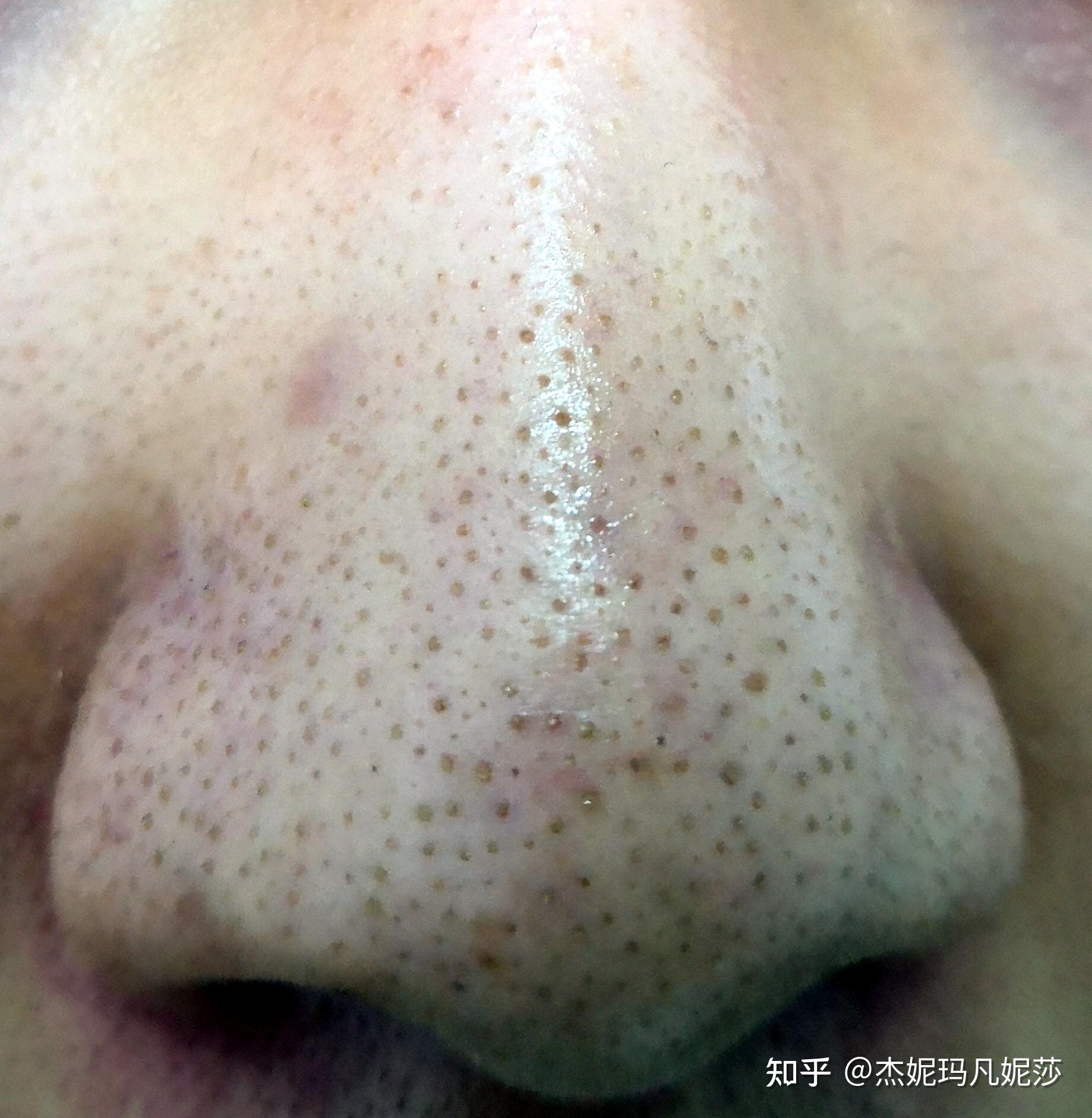 脸上毛孔粗大应该是油性皮肤有黑头有时候会有痘痘有没有好用男士洗面