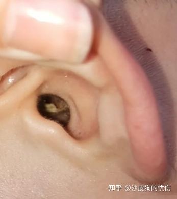 耳朵深处耳屎很多,掏不出来是怎么回事?该怎么办?