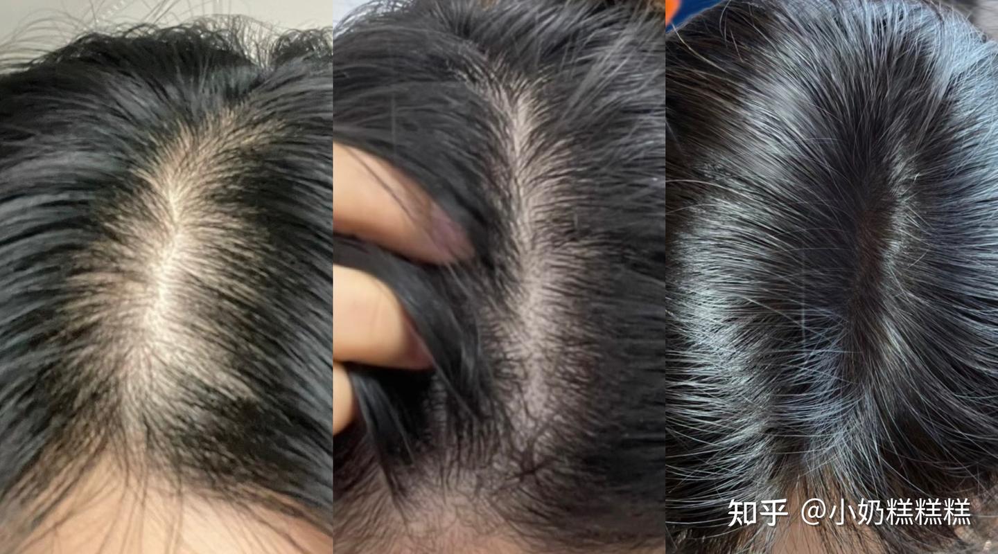 感觉头发越来越少,大把大把的掉,每天梳头差点掉成秃子。。跪求一个真实有效的防脱方法?!! - 知乎