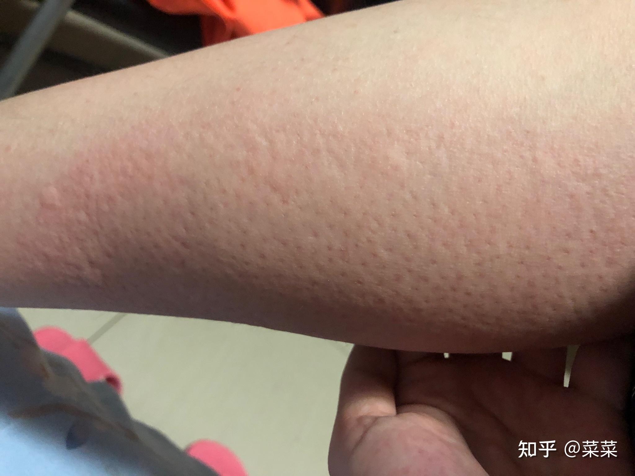 风油精过敏怎么办? - 知乎