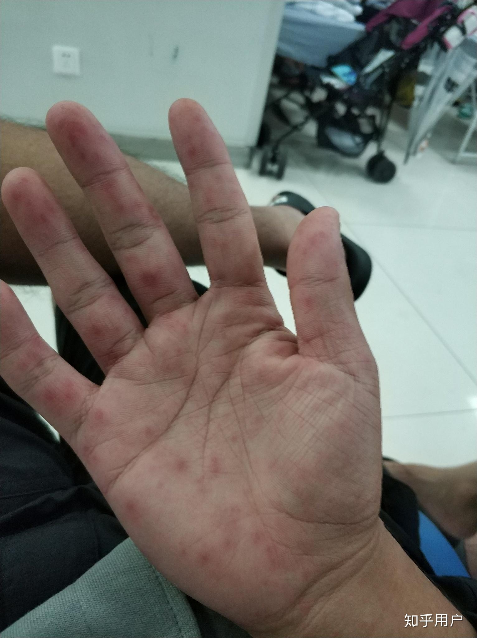 成年人得手足口病什么感觉