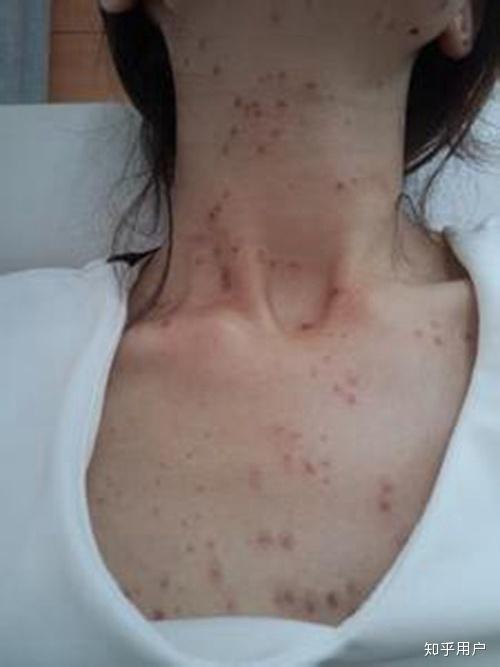 扁平疣八年久治不愈,该怎么办? - 知乎