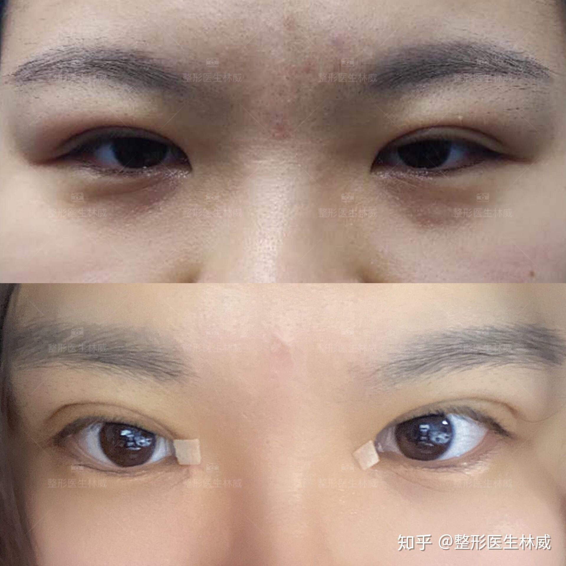 这种上眼皮属于脂肪厚还是肿啊