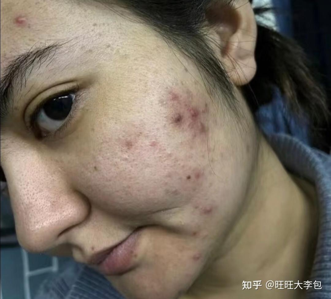 用针把痘痘弄破,会好吗? - 知乎