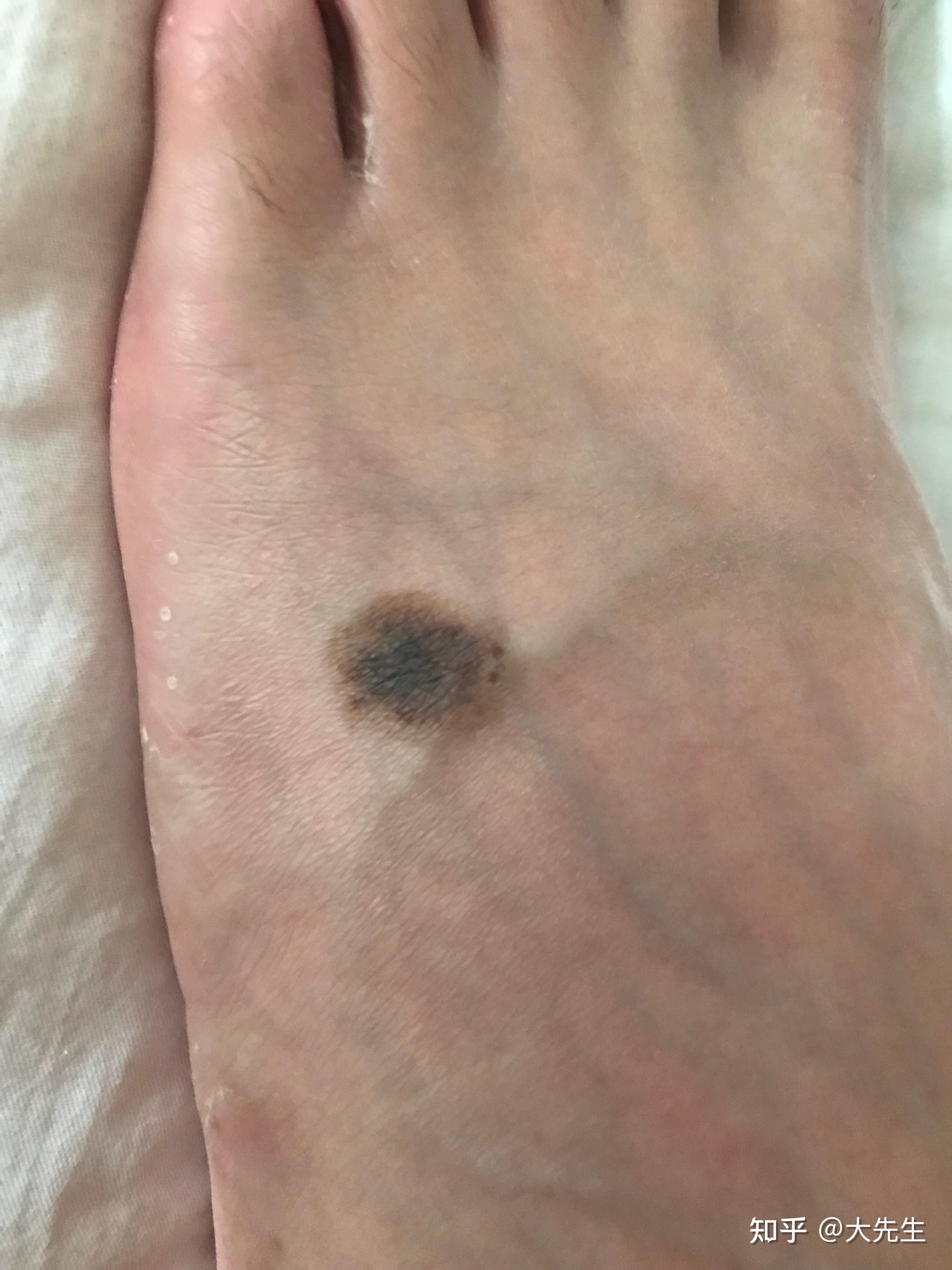 老公脚上有个很大的黑痣我害怕是黑色素瘤婆婆说我想多了那个痣是我