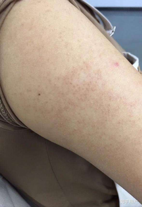 怎样去除手臂鸡皮