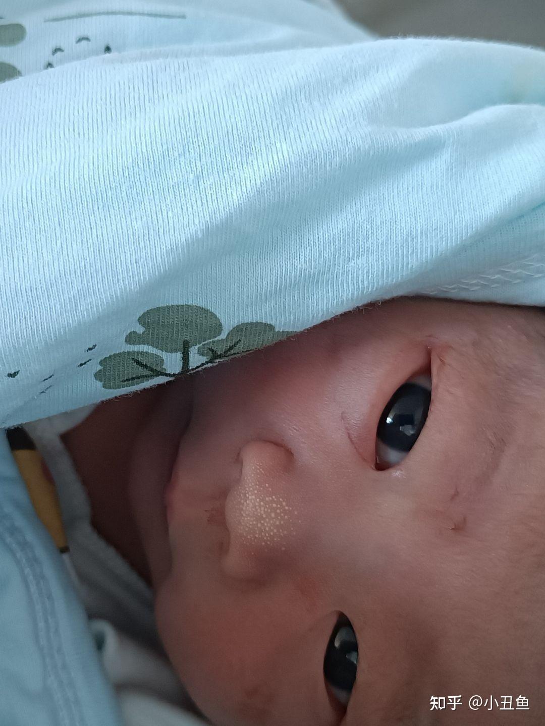 [助产技术]"脸色发紫"的新生儿你见过吗？