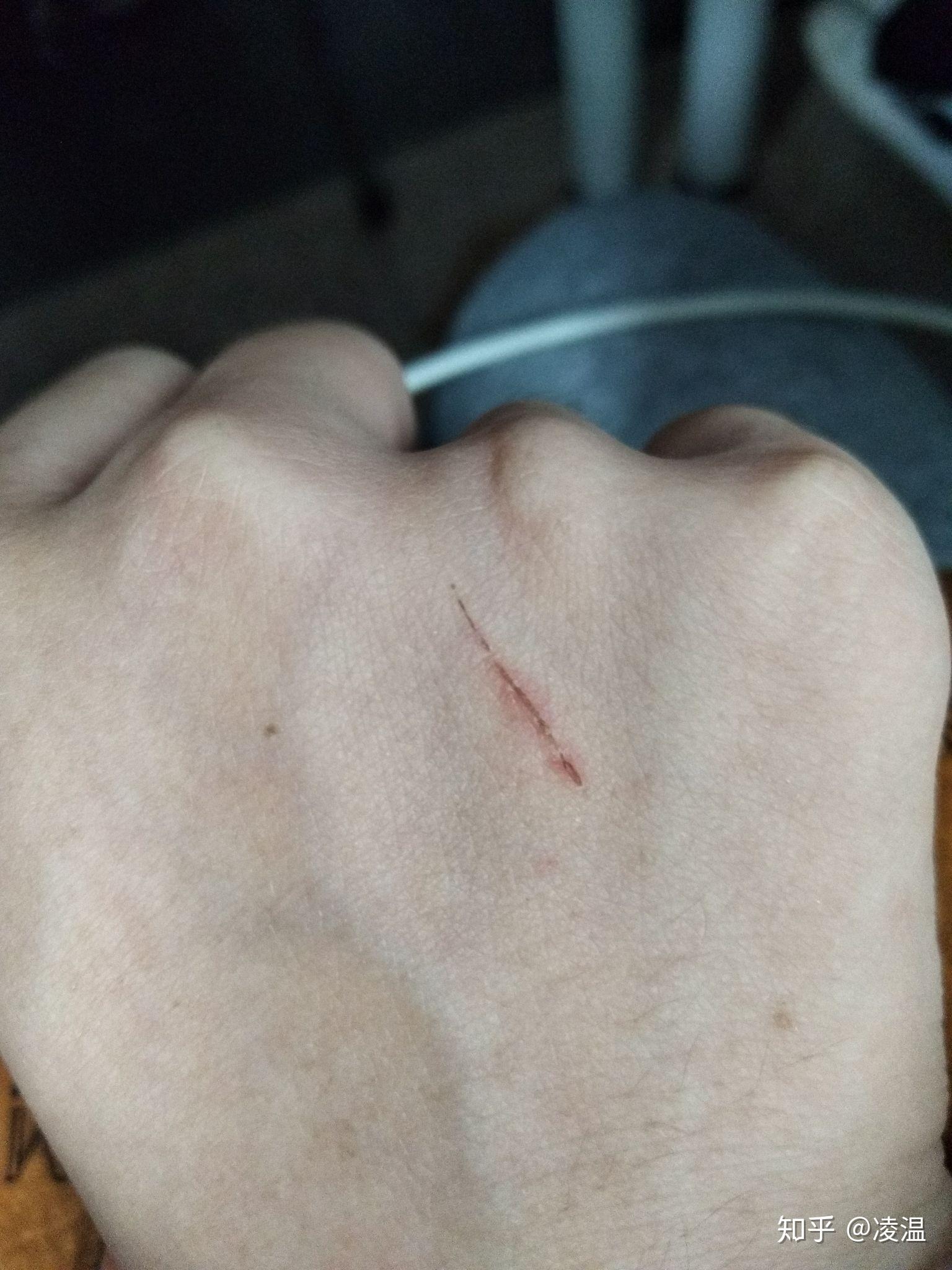 被猫抓破出血了会有事吗? - 知乎