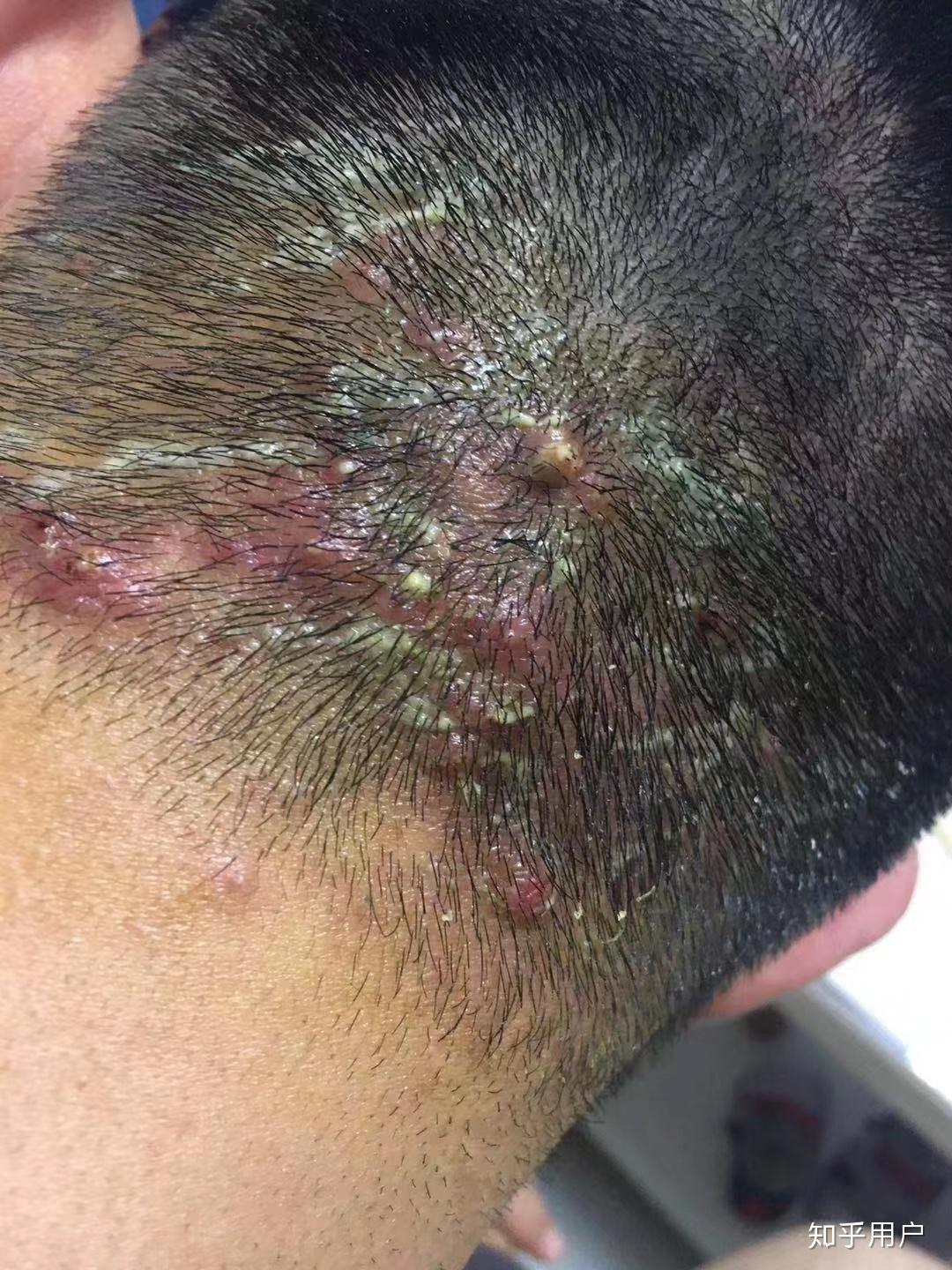 请问怎么区分头皮银屑病和脂溢性皮炎?(有图) - 知乎