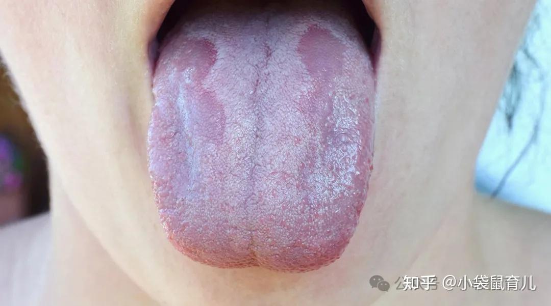 儿童口腔鹅口疮（适用于0-8岁） - 知乎