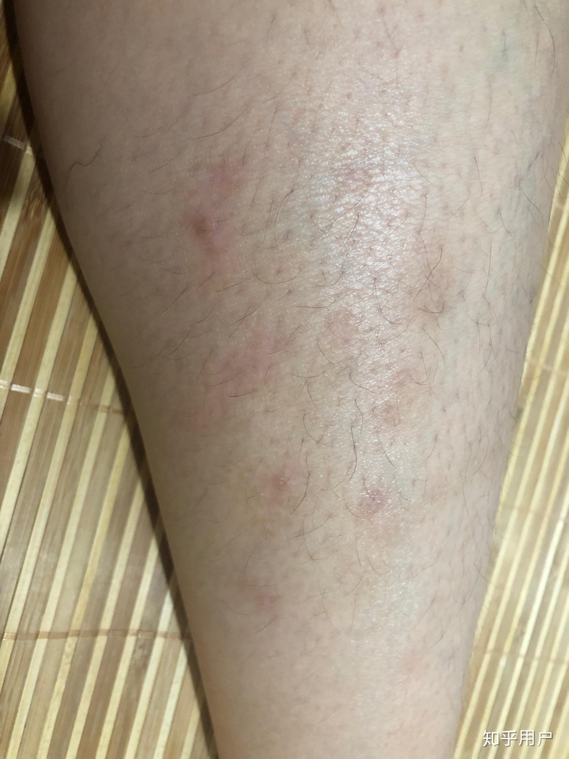 小腿特别痒,持续了两个月了,一直不好,越挠越痒挠破皮结了一腿的疤?