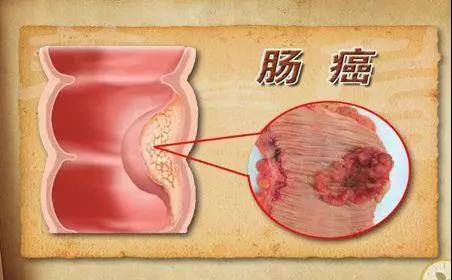 直腸癌到了中晚期,還能活多久?