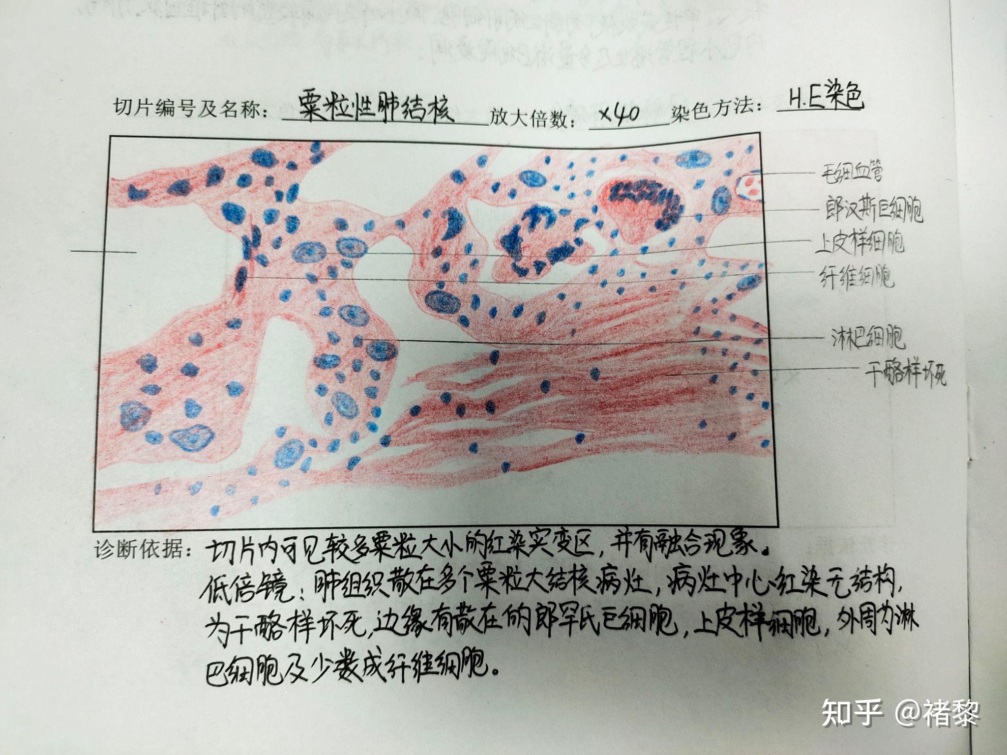 有没有人有病理的结肠腺癌红蓝铅笔手绘图啊