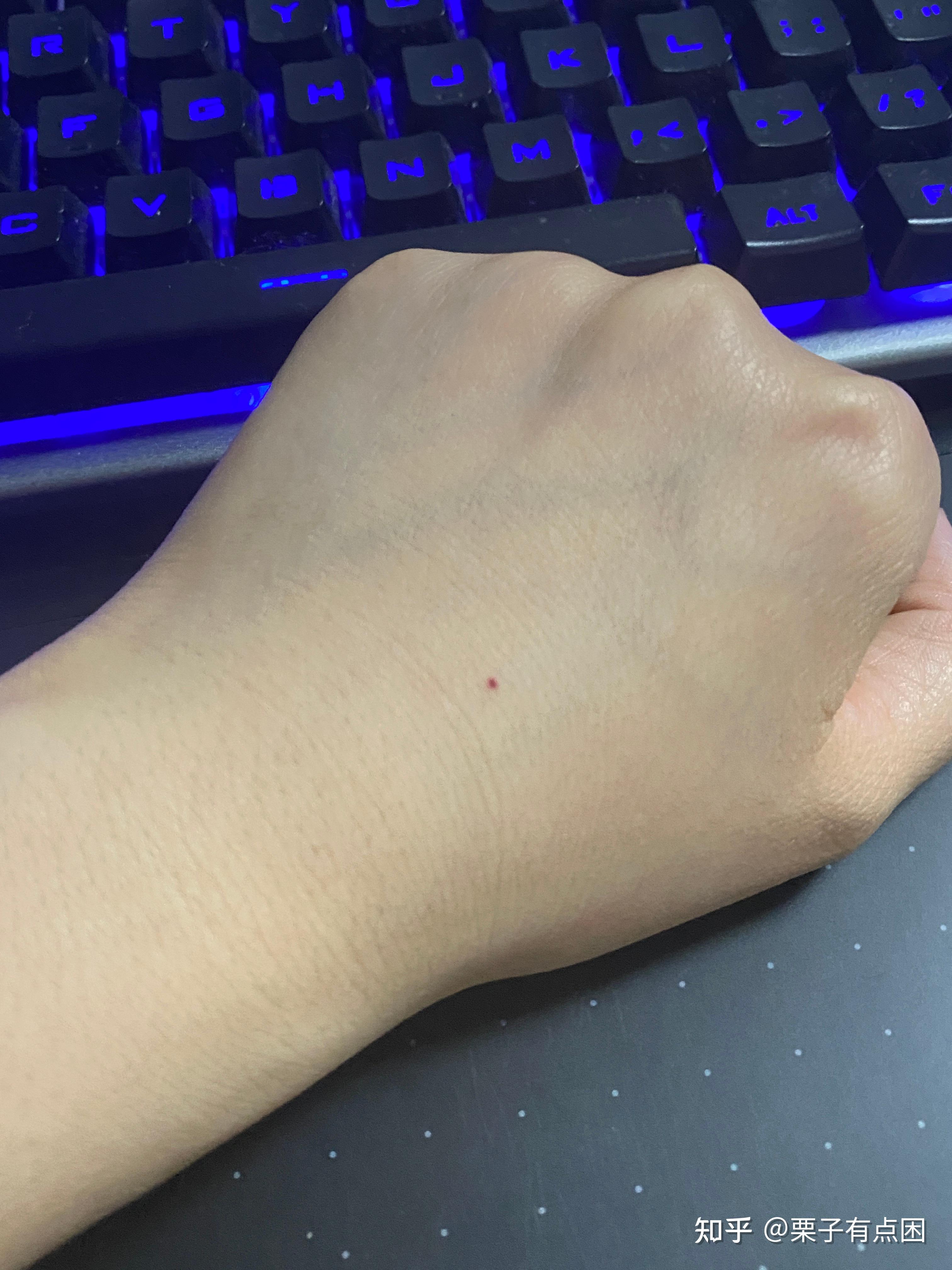 皮肤出现不少出血点小的如针尖大小呈扁平状大的如小米般大小呈凸起状