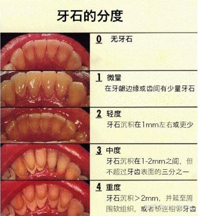 牙龈出血你知道危害有多大吗