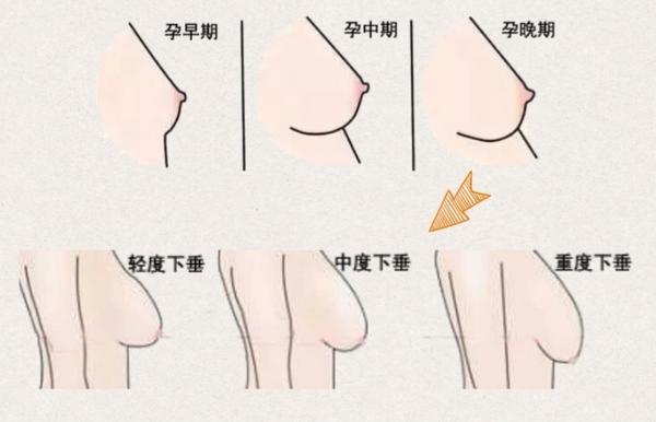 哺乳期后胸部一定会缩水吗