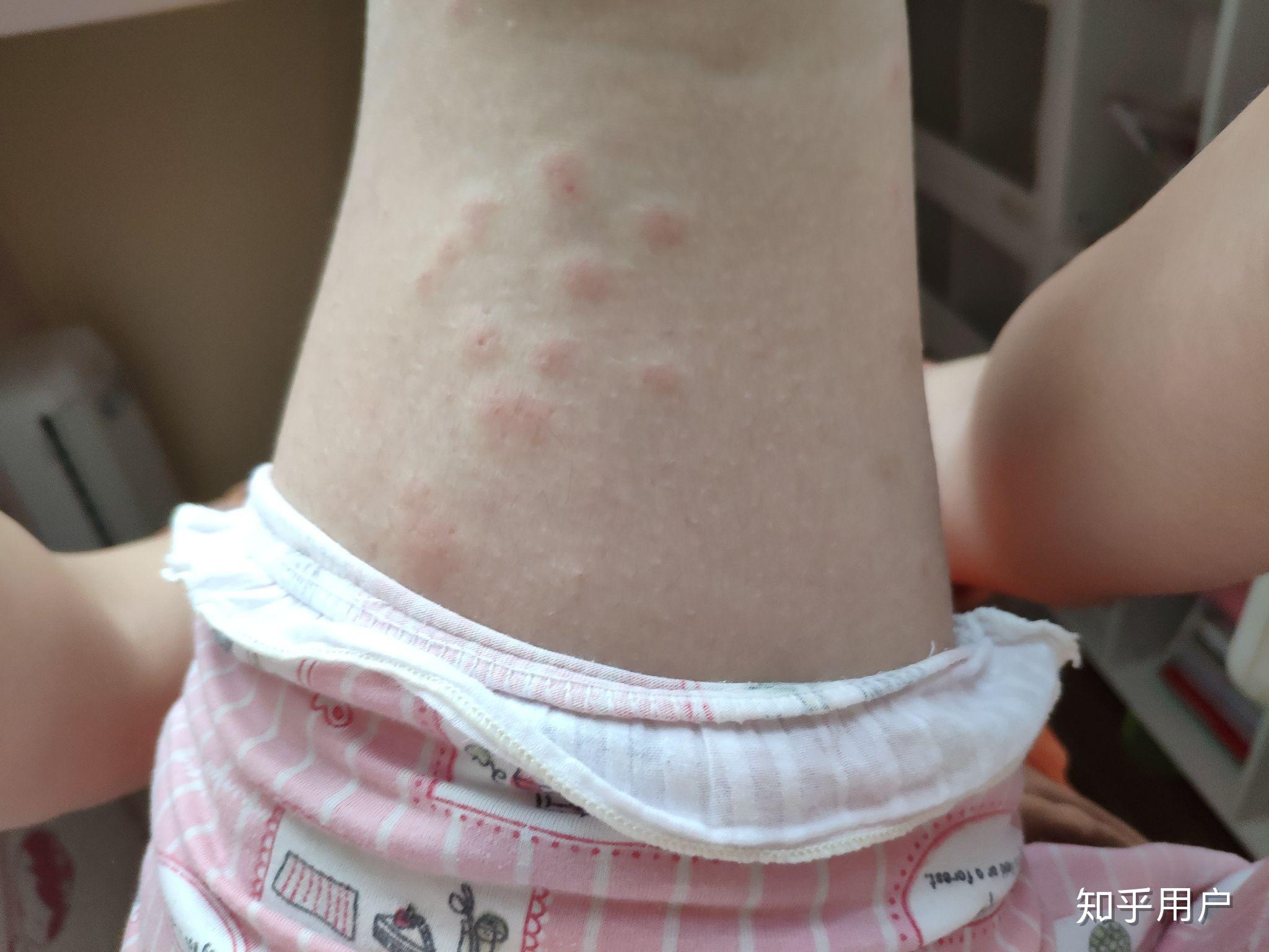 被跳蚤咬的全身都是包是什么样的感受