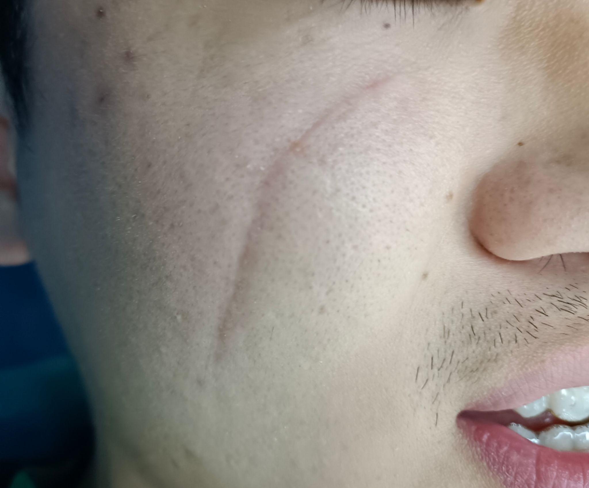 怎么样才能去掉脸上的凹陷型疤痕啊,广告不要来好不好 ,目前也没有钱