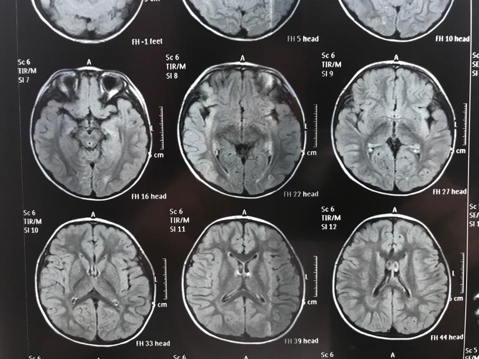 磁共振双侧半卵圆中心及侧脑室后角旁白质异常信号考虑扩大的血管周围