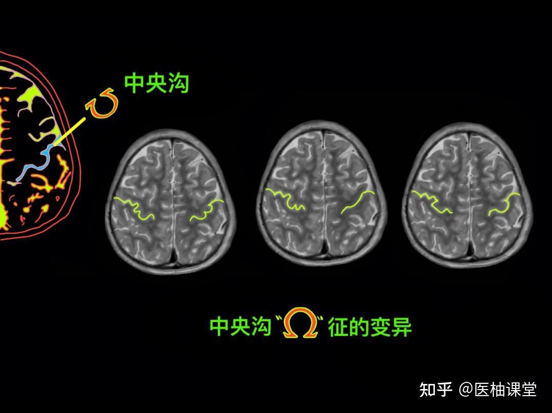头颅MR阅片手绘(精华版) - 知乎