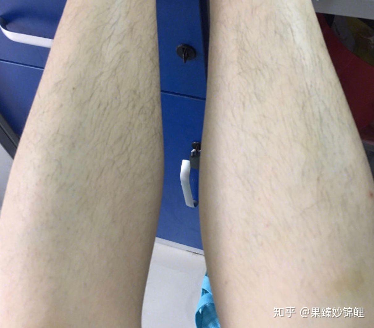 脱腿毛真的会越长越长吗