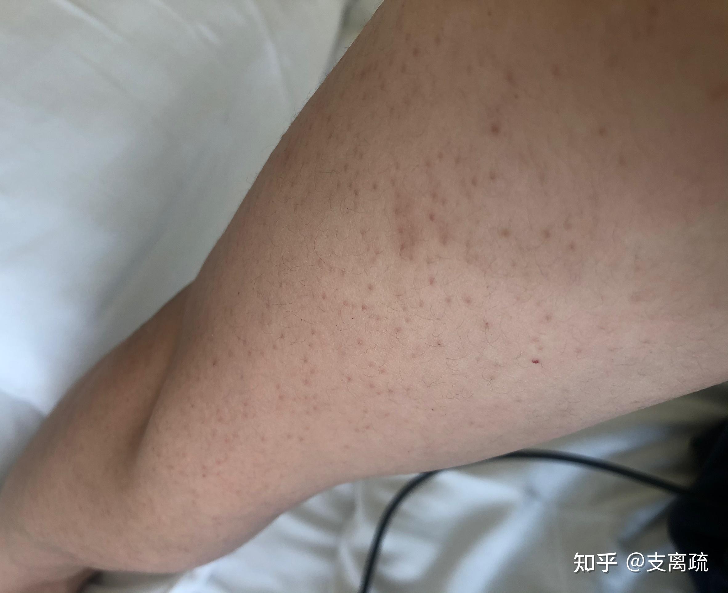 为什么鸡皮肤洗完澡就红(为什么鸡皮肤洗完澡就红红的)