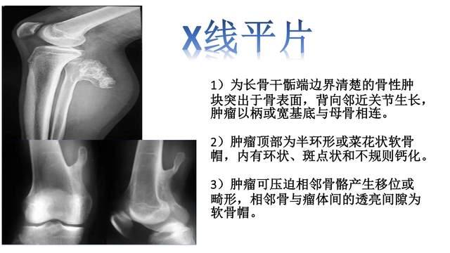 骨肉瘤影像图怎么看? - 知乎