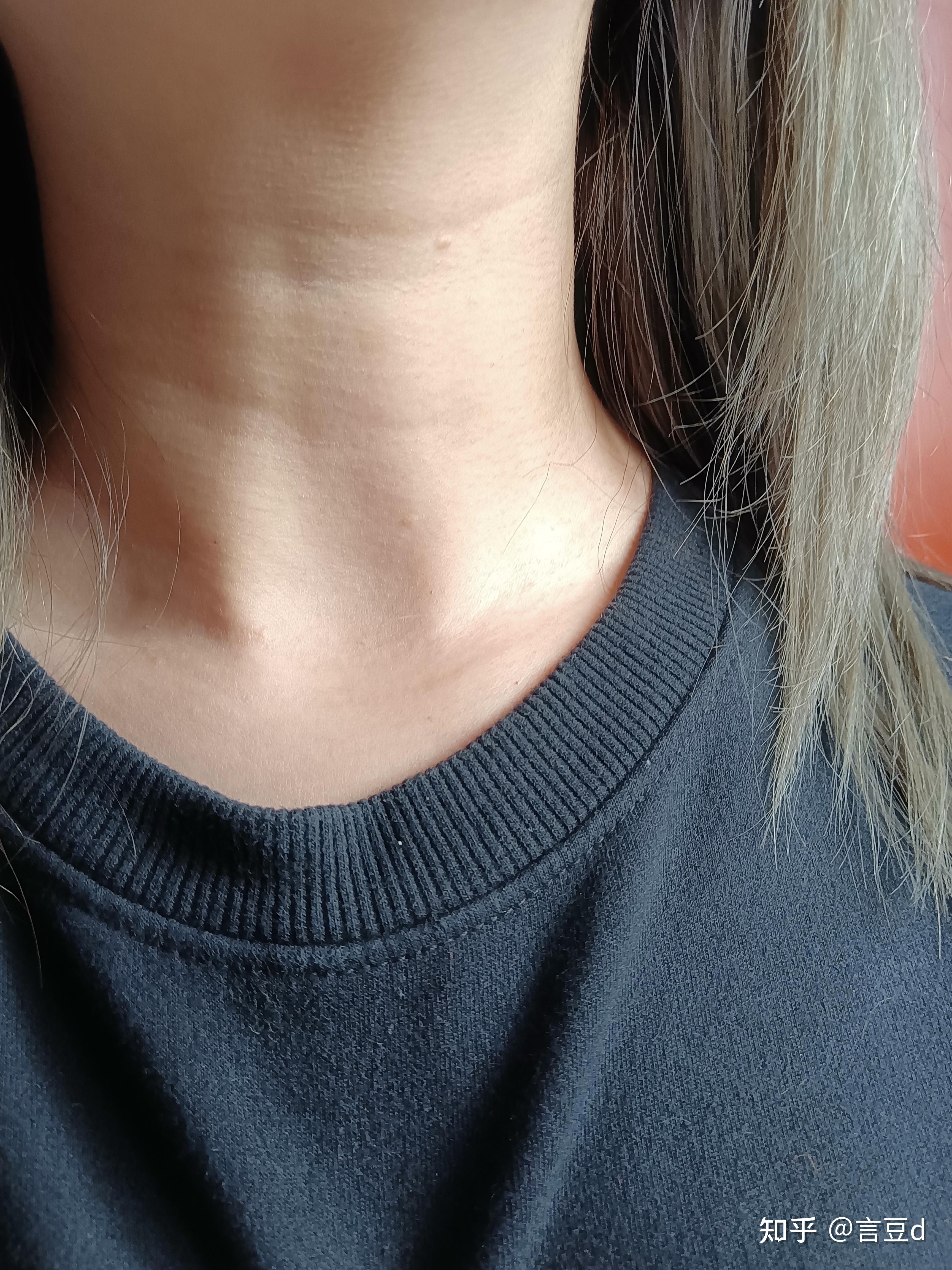 身上长小肉粒是怎么回事? - 知乎