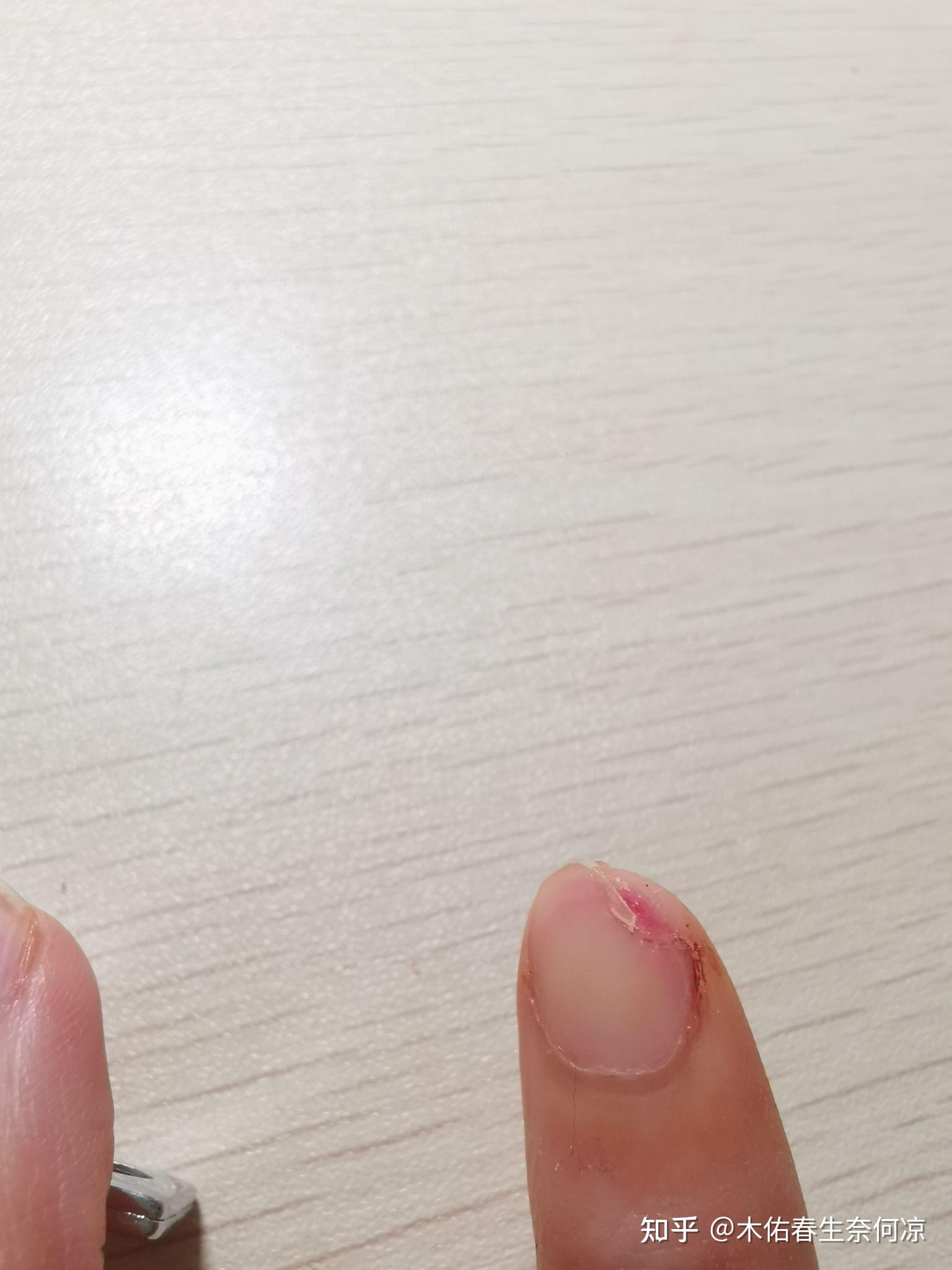 指甲从中间断了怎么快速愈合
