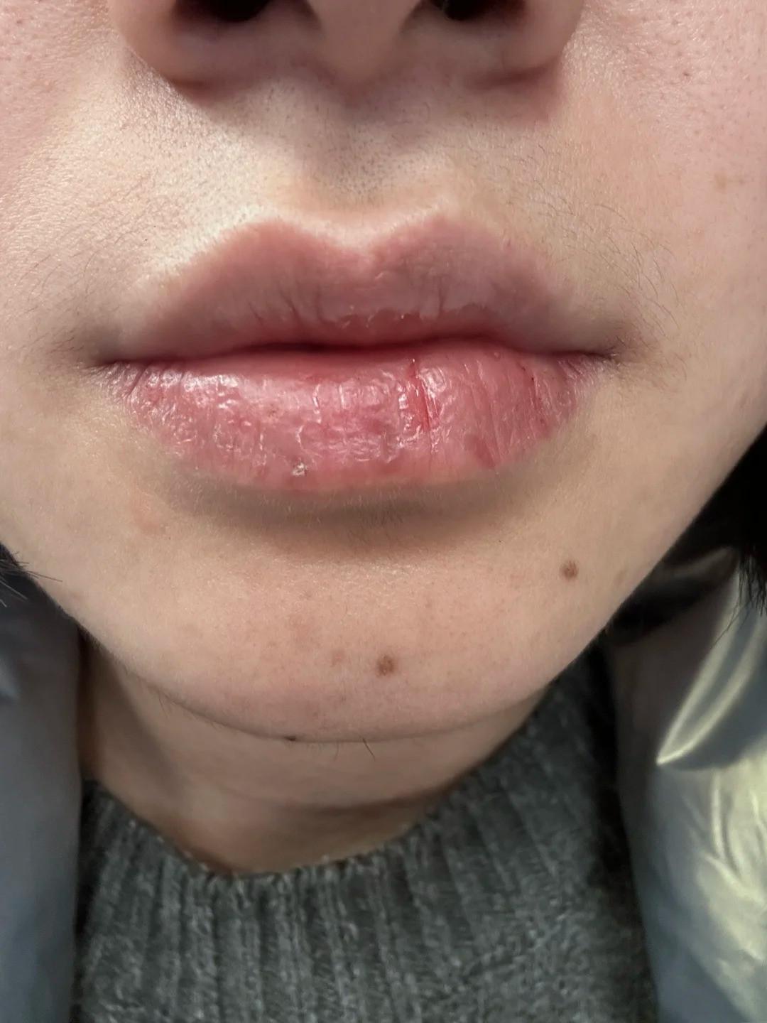 嘴唇经常干裂,起皮怎么办?