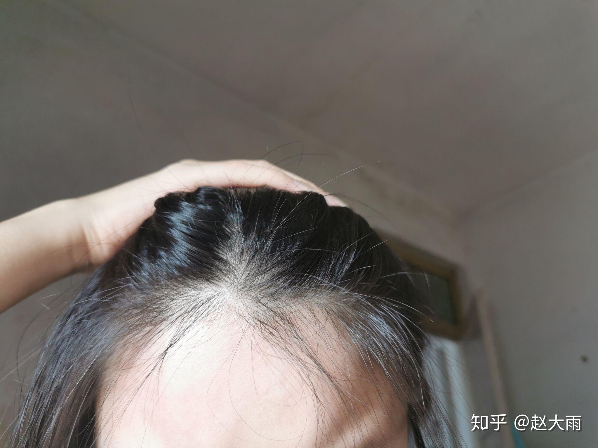 女生 发量少 头顶快秃了 有没有什么好的生发方法!跪求! - 知乎