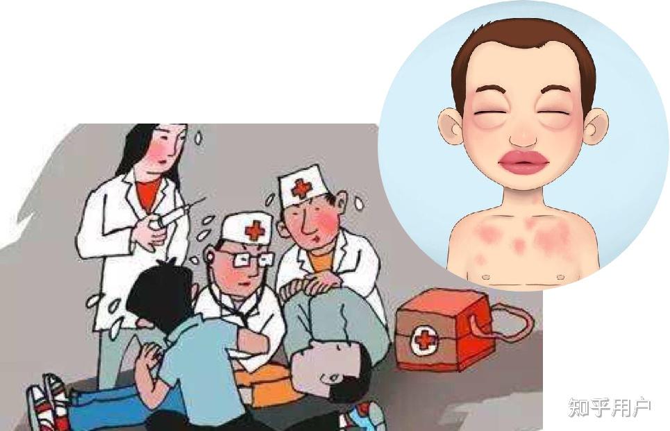 严重过敏反应常见的症状有哪些? - 知乎
