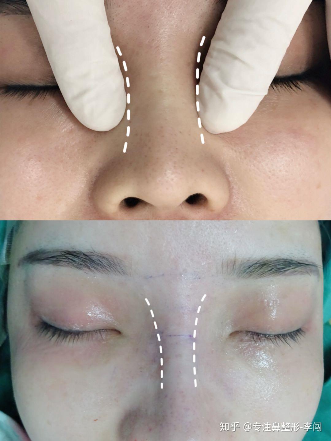 有鼻骨宽的做鼻骨内推手术的吗? - 知乎