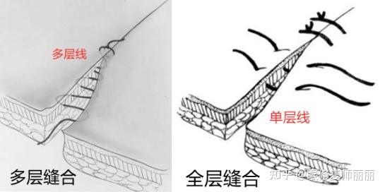 师丽丽眼修复丨相比于多层缝合 我更主张全层缝合（尤其针对初眼和中轻度眼修复） - 知乎