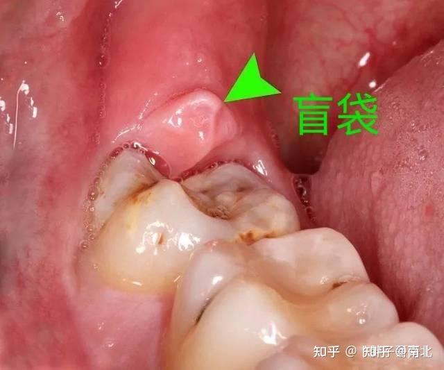 智齿，冠周炎，半夜疼醒，治疗经历分享 - 知乎