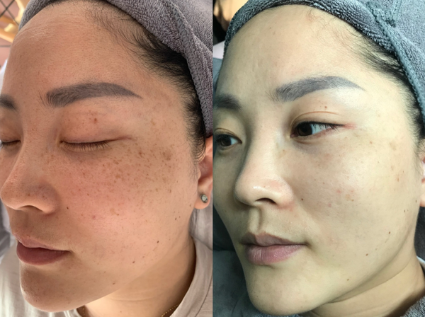 为了让大家对整个皮秒祛斑过程和价格,效果有更真切的感受,跟着美商