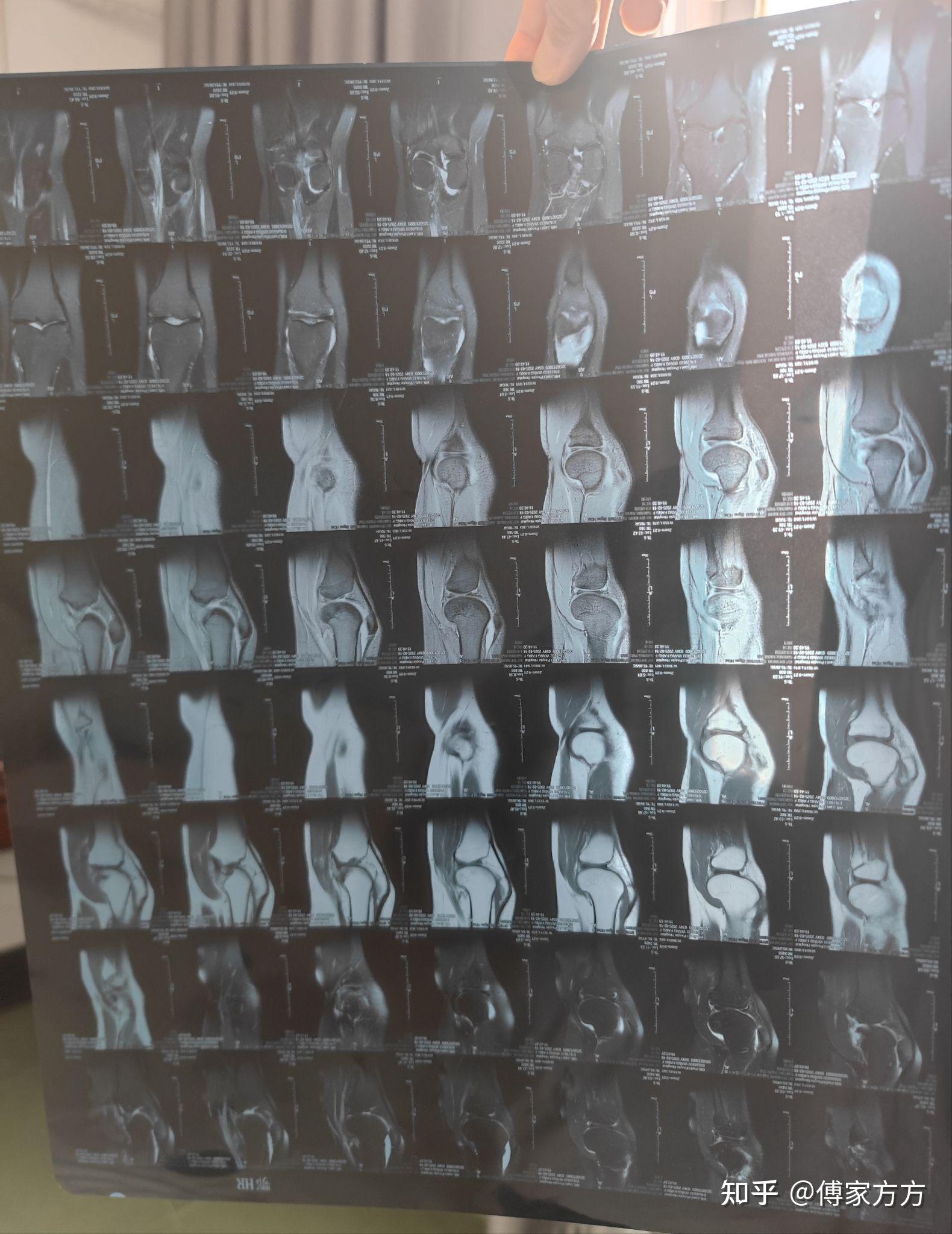 左膝半月板前后角损伤1